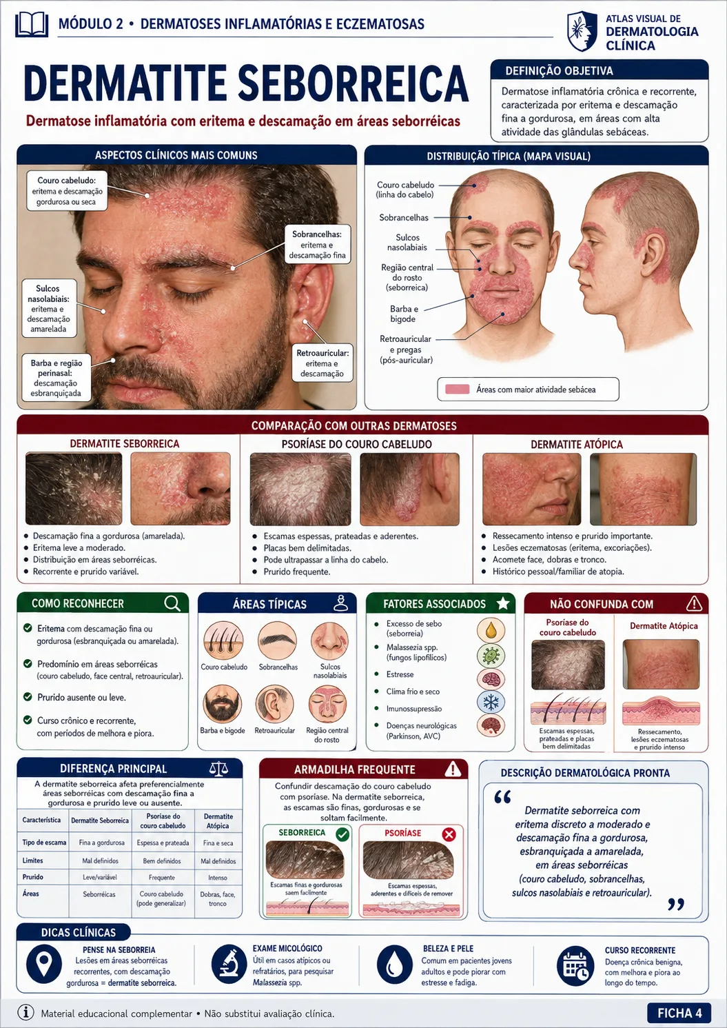Ficha visual sobre dermatite seborreica do módulo de dermatoses inflamatórias e eczematosas